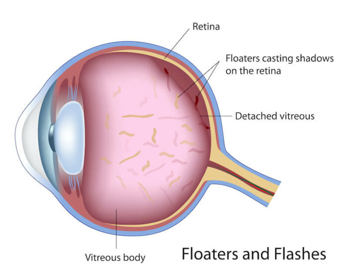 Floaters and Flashes diagram