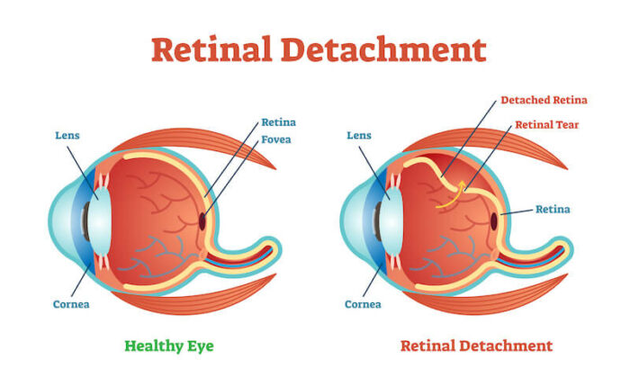 Retinal detachment diagram